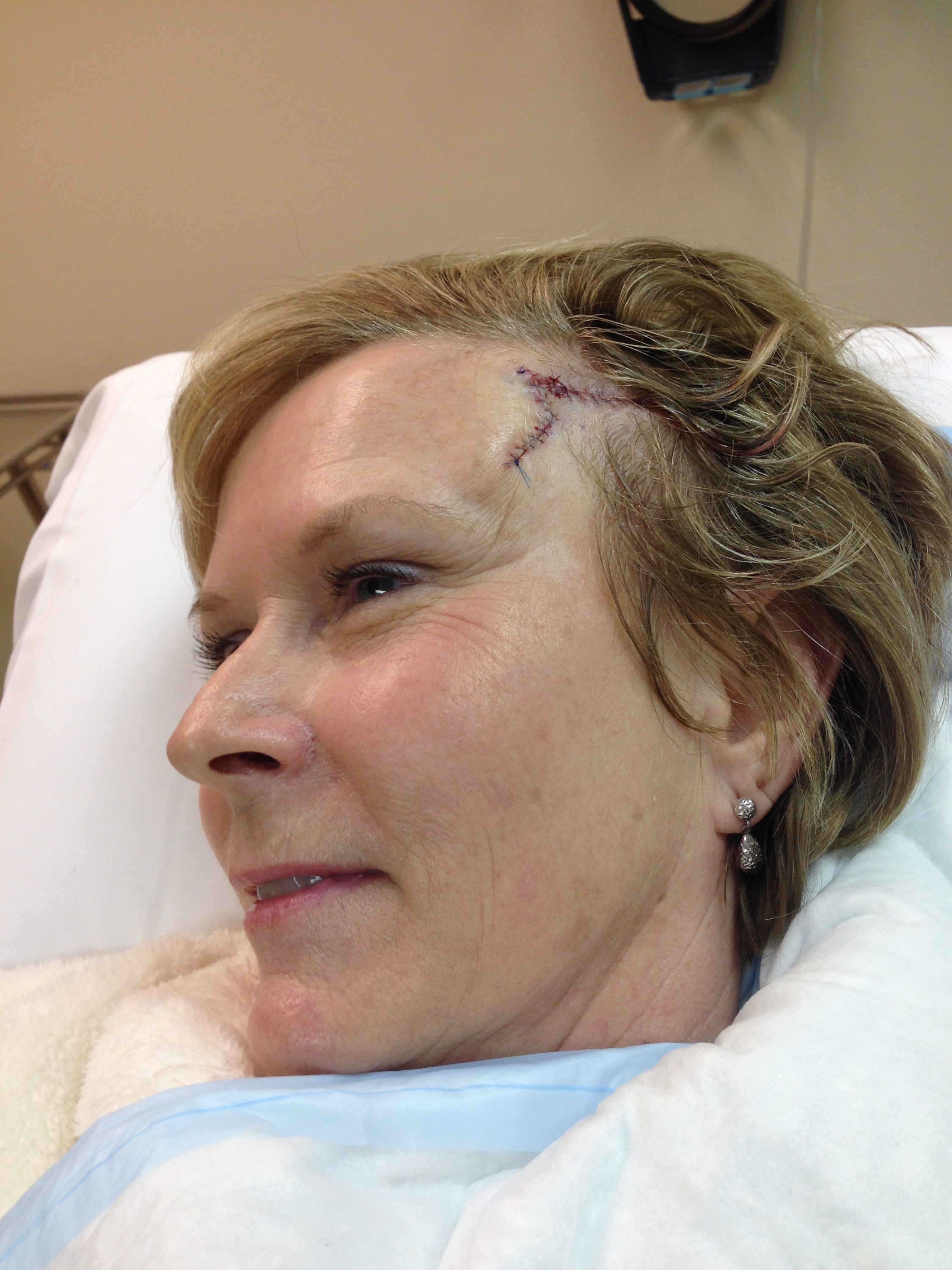 2014-03-05 11-45-33 Basal Cell Carcinoma surgery.jpg